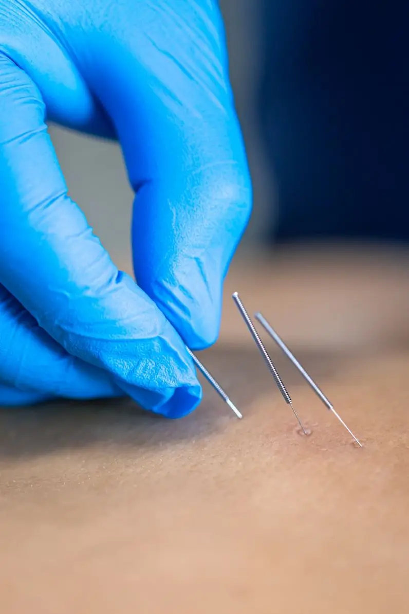 close-up-needle-hands-physiotherapist-doing-dry-needling Augusta Acupuncture Clinic | Top Augusta Clinic for TMJ and Acupuncture